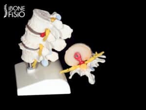 Các Phương Pháp Mới Xua Tan Nỗi Lo Về Cột Sống Vôi Hóa