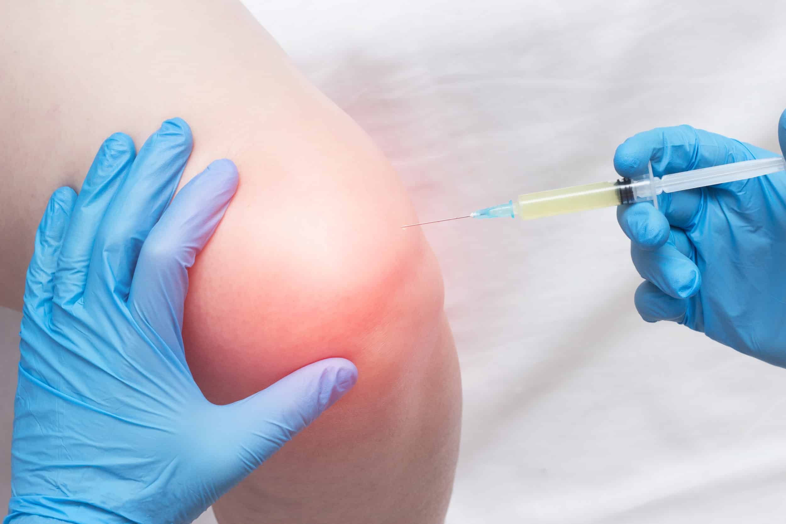 Ghép tế bào gốc collagen thuỷ phân, công nghệ mới trong điều trị bệnh xương khớp Ghép tế bào gốc collagen thuỷ phân, công nghệ mới trong điều trị bệnh xương khớp