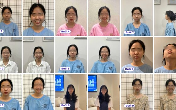 So sánh khuôn mặt trước và sau khi điều trị lệch mặt