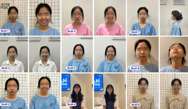 So sánh khuôn mặt trước và sau khi điều trị lệch mặt