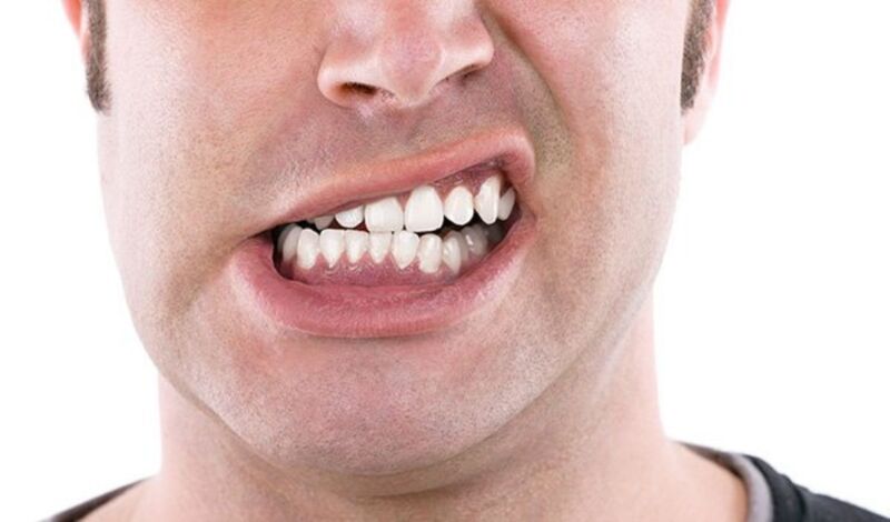Lệch mặt và sai khớp cắn vĩnh viễn, các biến chứng về thẩm mỹ và chức năng nhai Lệch mặt và sai khớp cắn vĩnh viễn, các biến chứng về thẩm mỹ và chức năng nhai