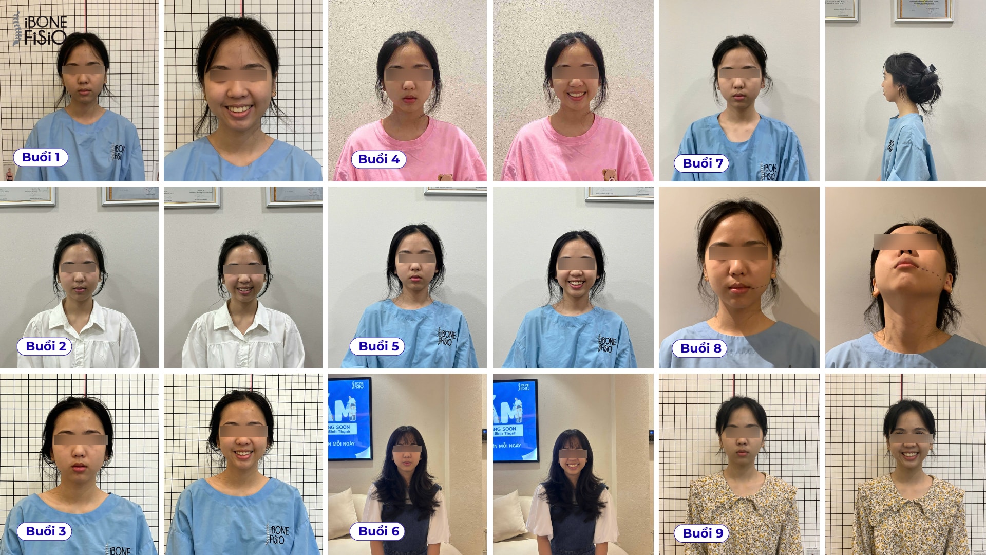 So sánh khuôn mặt trước và sau khi điều trị lệch mặt