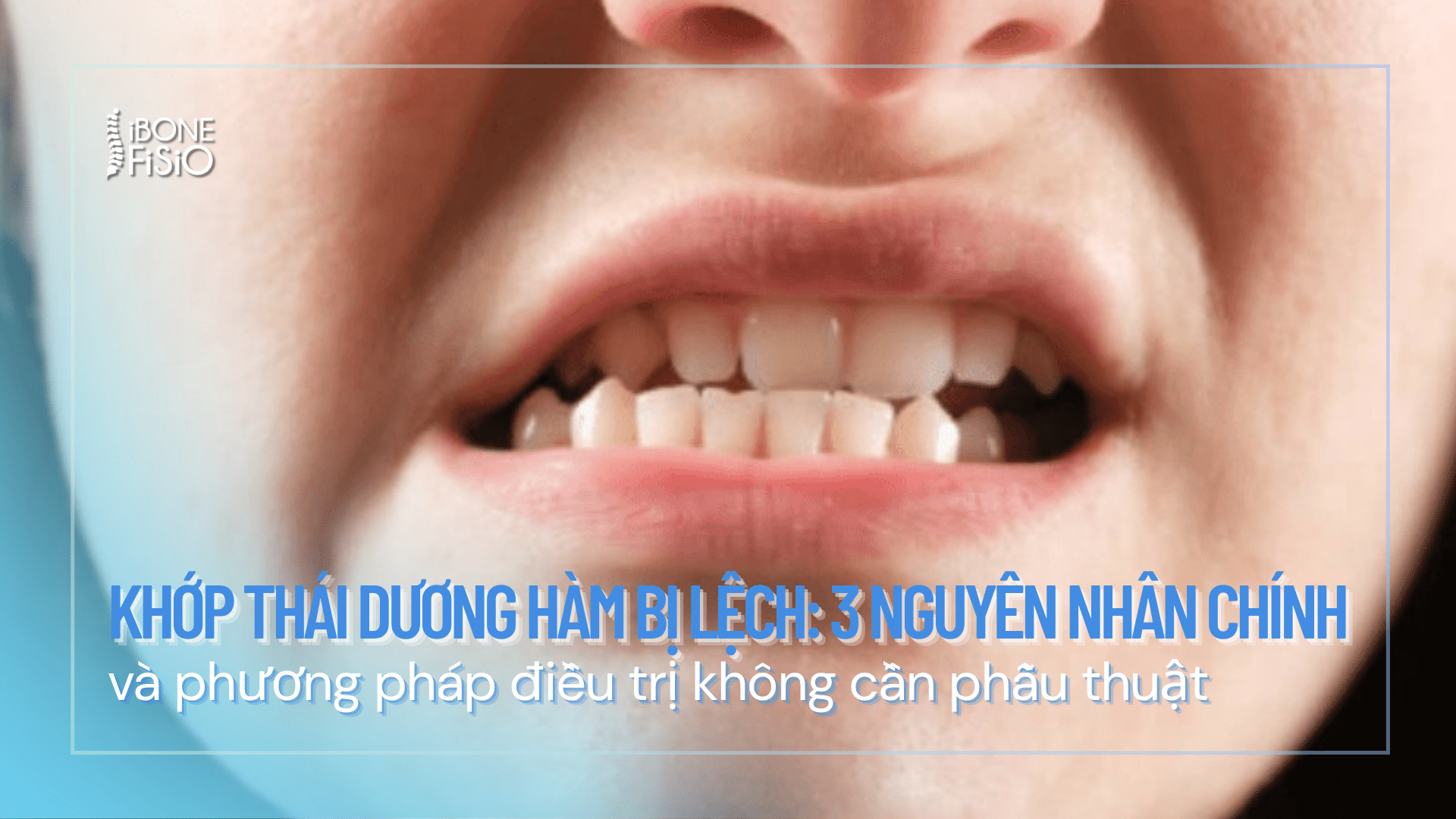 khop thai duong ham bi lech