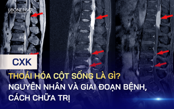 Thoái hóa cột sống là gì? Nguyên nhân và giai đoạn bệnh, cách chữa trị
