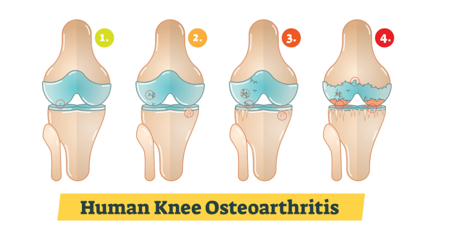 Viêm khớp gối: Nguyên nhân, dấu hiệu và phác đồ điều trị chuẩn Y khoa 6 3 giai đoạn viêm khớp gối
