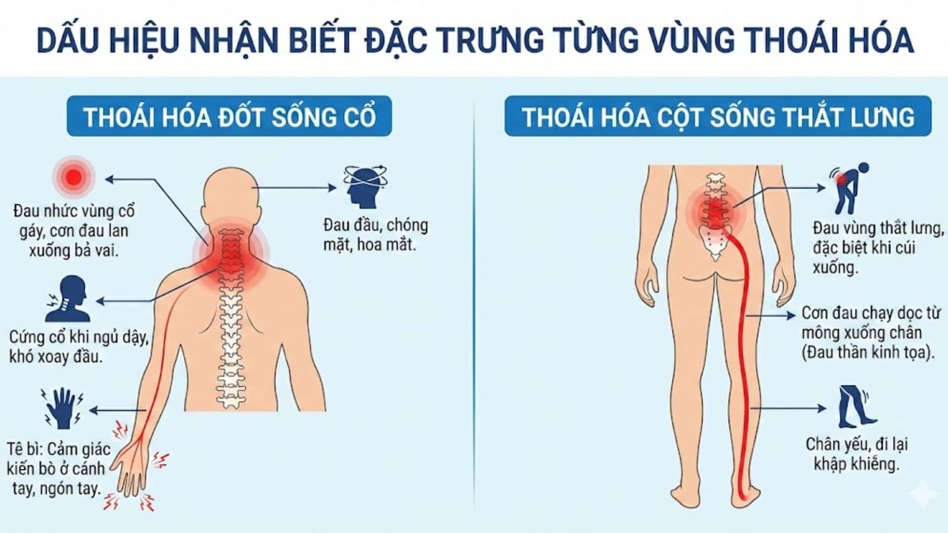 Thoái hóa cột sống là gì? Nguyên nhân và giai đoạn bệnh, cách chữa trị 5 Dấu hiệu nhận biết đặc trưng từng vùng