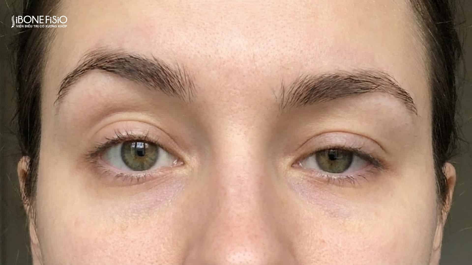 Dấu hiệu nhận biết lệch mặt: 5 Cách tự kiểm tra chuẩn xác tại nhà 4 Đôi lông mày và mắt không đều