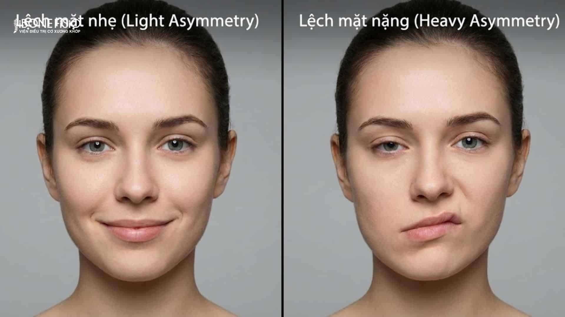 Lệch mặt là gì? Nguyên nhân, dấu hiệu và cách khắc phục hiệu quả 3 Lệch mặt TMJ