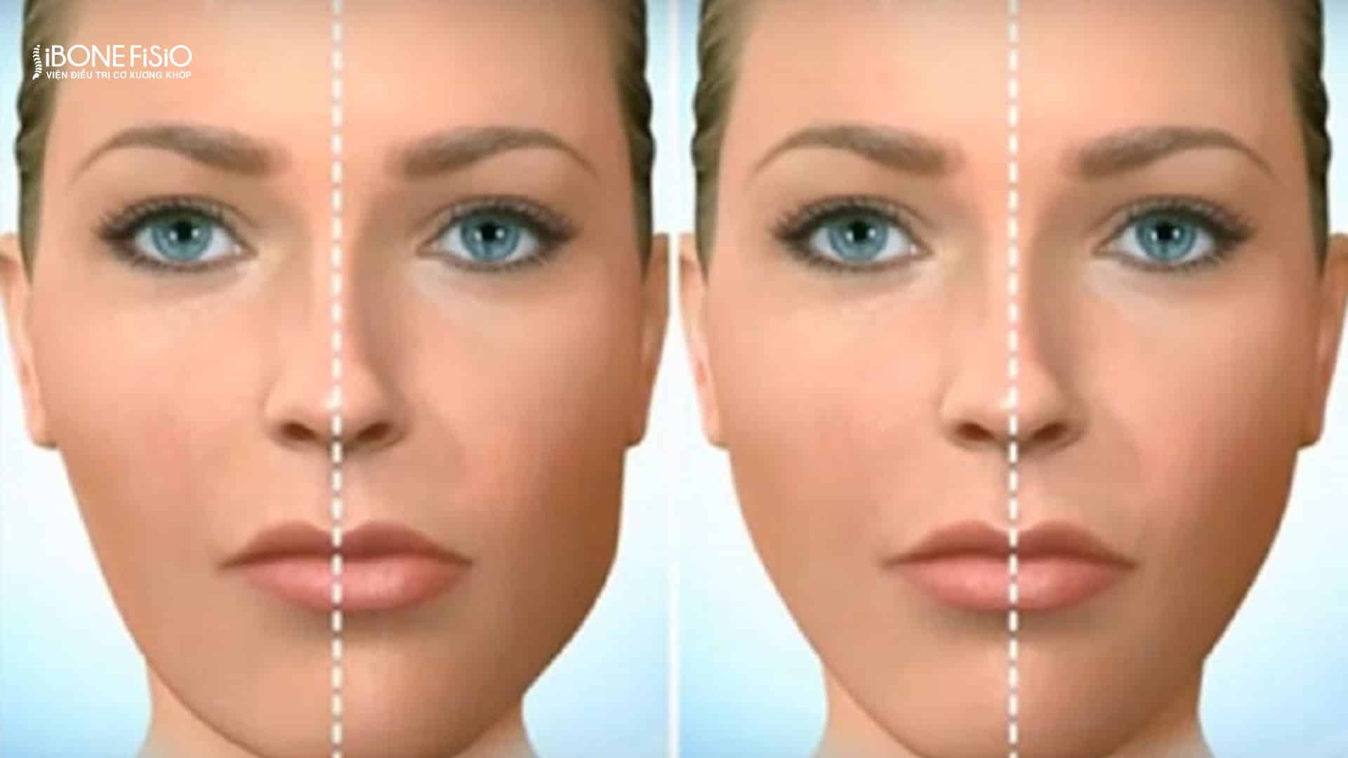 Lệch mặt là gì? Nguyên nhân, dấu hiệu và cách khắc phục hiệu quả 2 Lệch mặt tình trạng bệnh phổ biến hiện nay