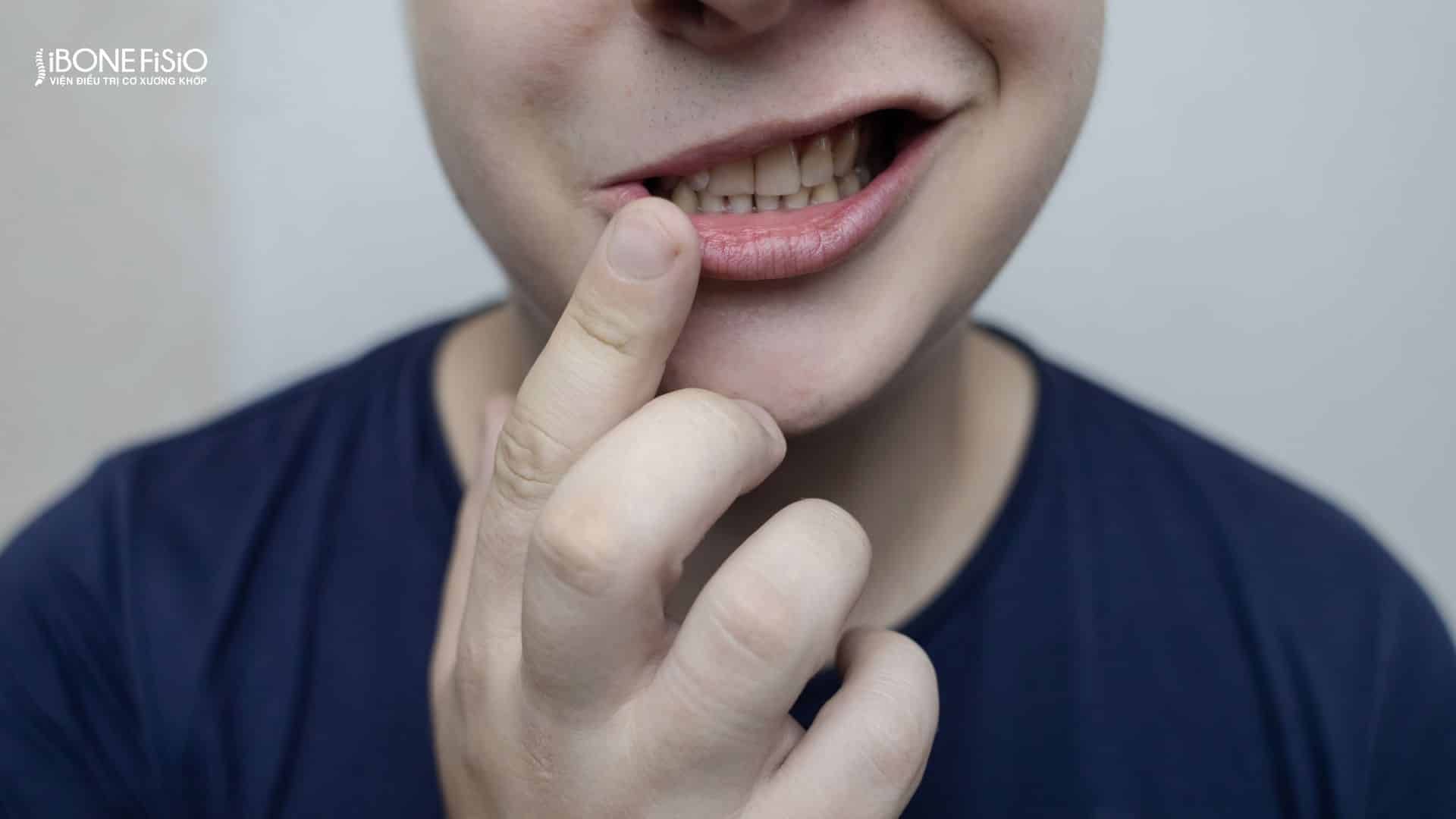 Lệch mặt là gì? Nguyên nhân, dấu hiệu và cách khắc phục hiệu quả 7 Lệch méo miệng