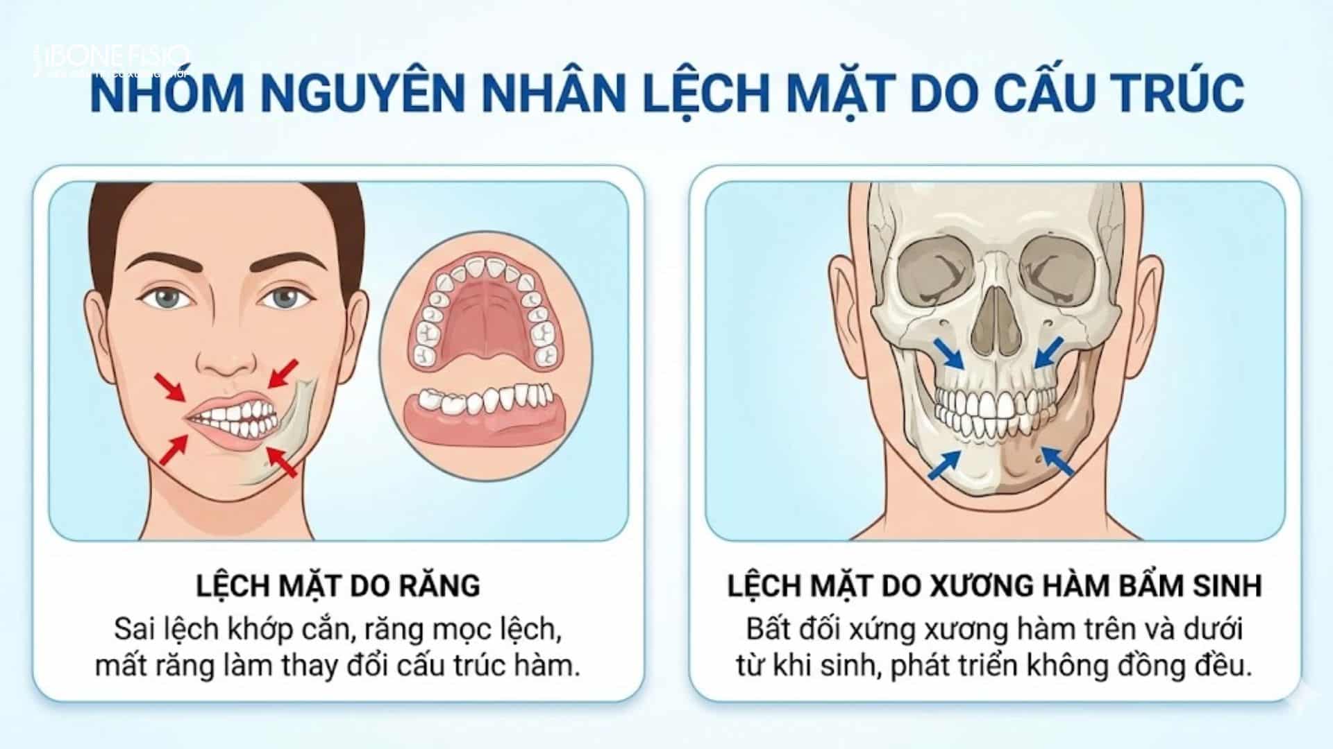 Nguyên nhân lệch mặt: 7 Thói quen tàn phá nhan sắc, cách khắc phục 5 Câu trúc nha khoa dẫn bị lệch