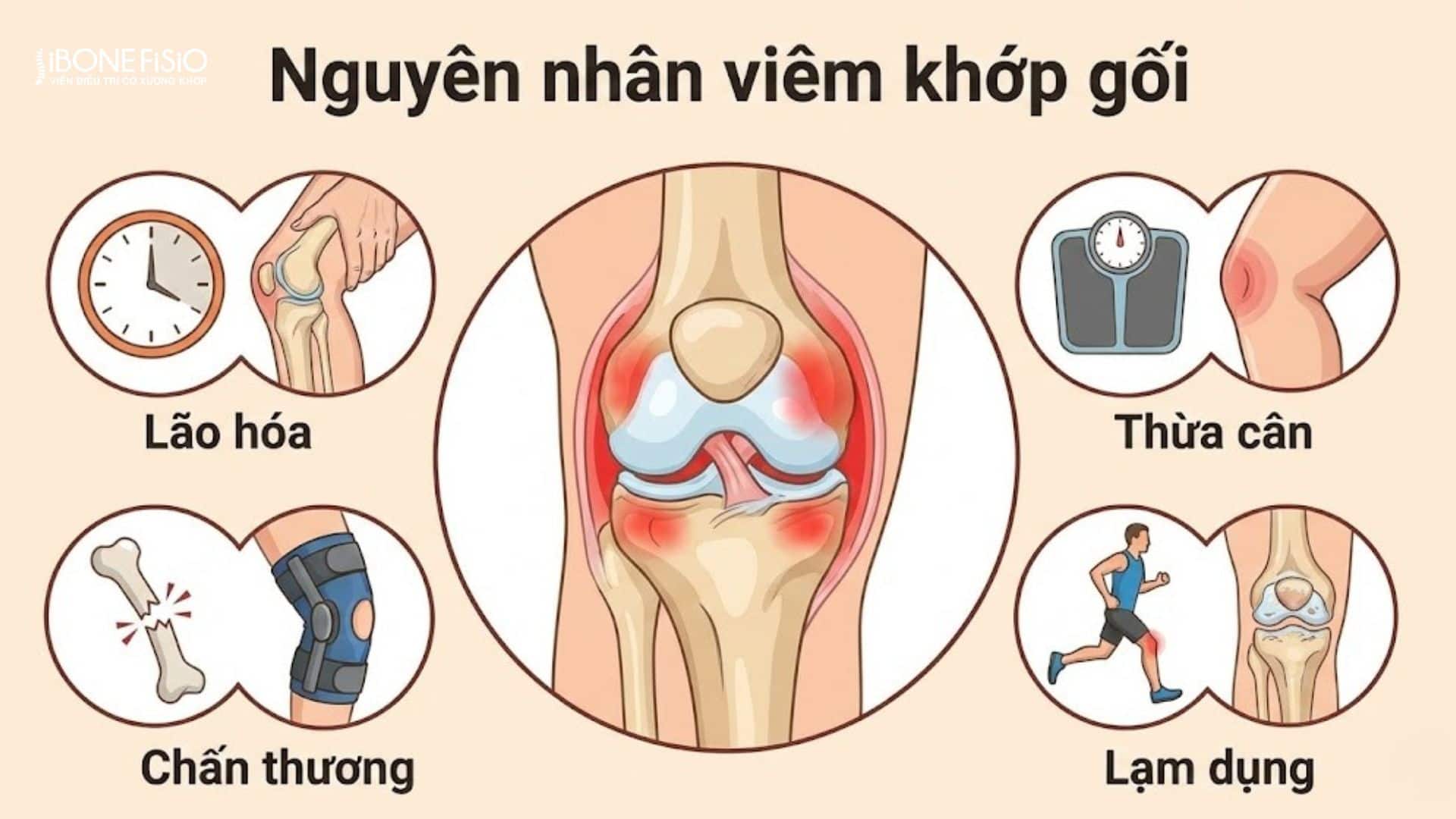 Viêm khớp gối: Nguyên nhân, dấu hiệu và phác đồ điều trị chuẩn Y khoa 5 Các nguyên nhân gây viêm khớp gối