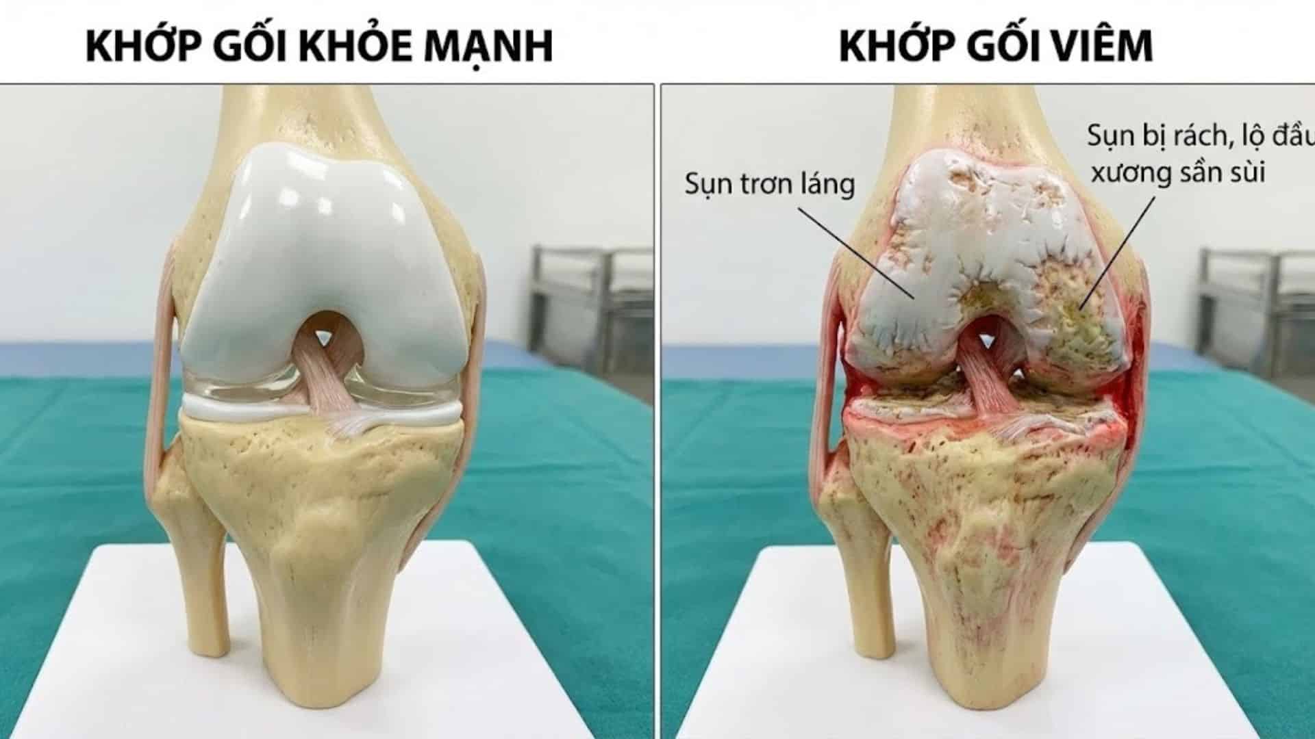 Viêm khớp gối: Nguyên nhân, dấu hiệu và phác đồ điều trị chuẩn Y khoa 3 So sánh khớp gối khỏe mạnh và khớp gối viêm