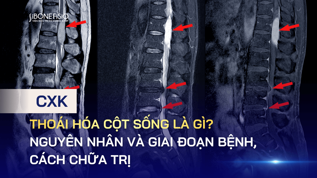 Thoái hóa cột sống là gì? Nguyên nhân và giai đoạn bệnh, cách chữa trị
