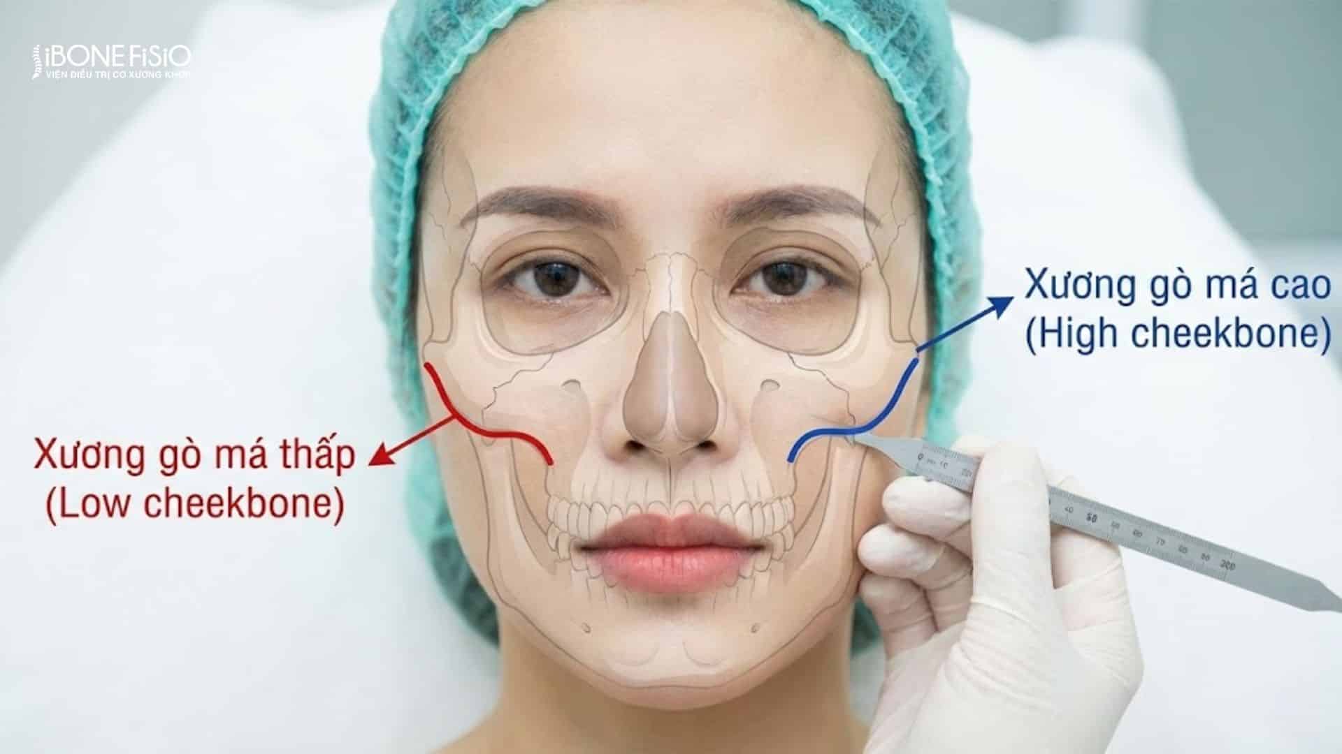 Dấu hiệu nhận biết lệch mặt: 5 Cách tự kiểm tra chuẩn xác tại nhà 5 Xương gò má cao hơn phải dùng biện pháp gọt hàm