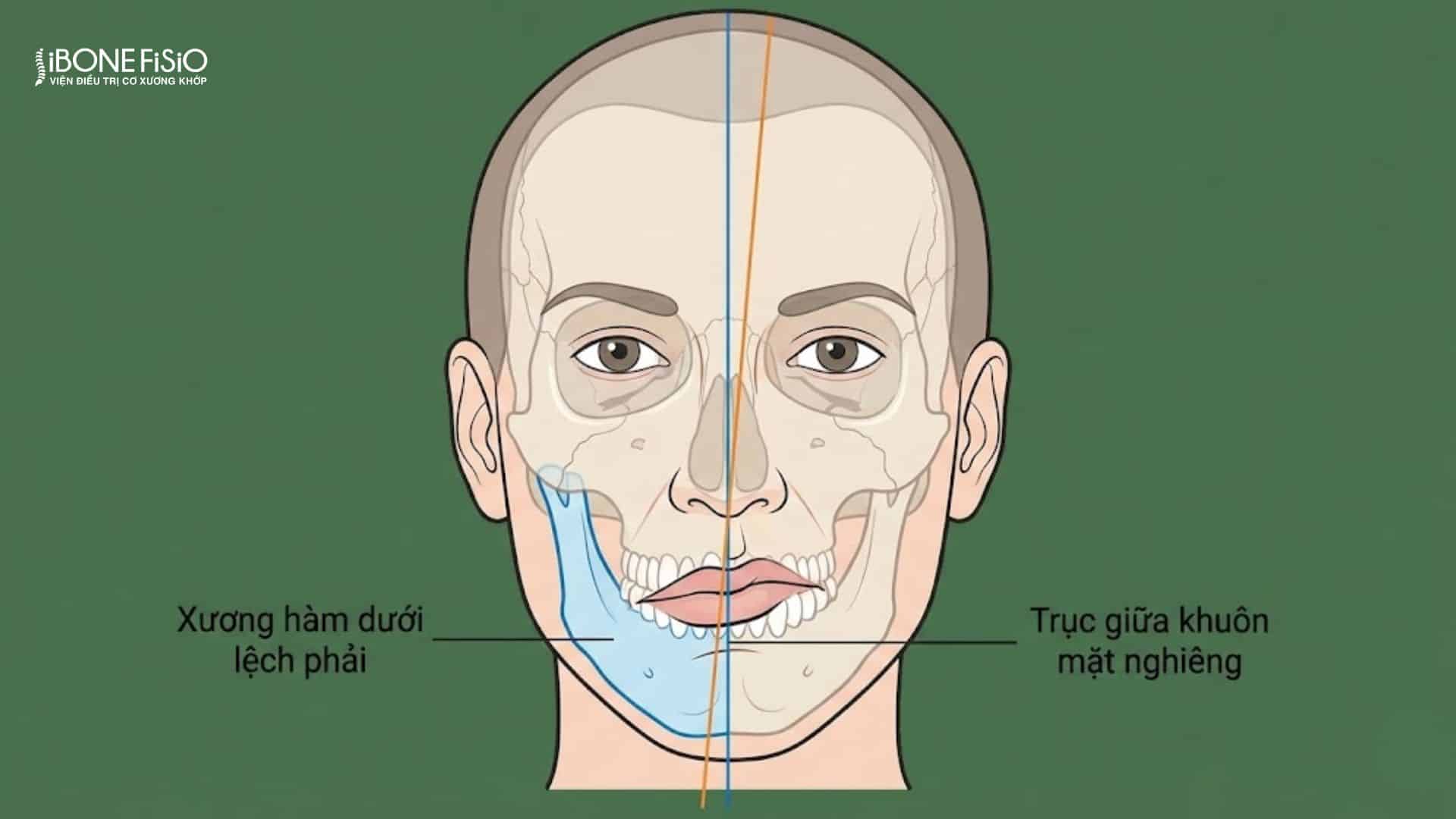 Nguyên nhân xương hàm bị lệch và cách khắc phục hiệu quả 2 Xương hàm bị lệch khiến khuôn mặt mất cân đối rõ rệt