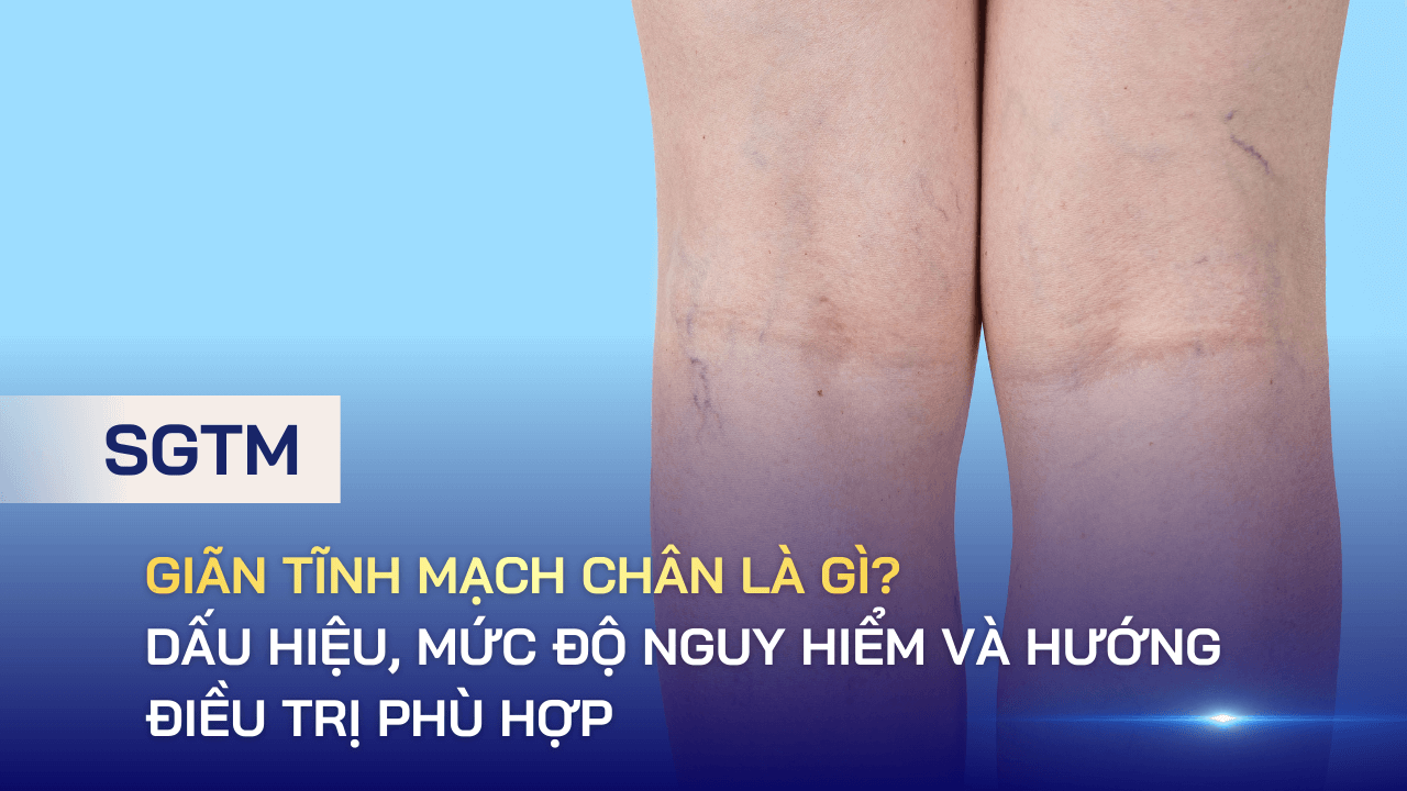 Giãn tĩnh mạch chân