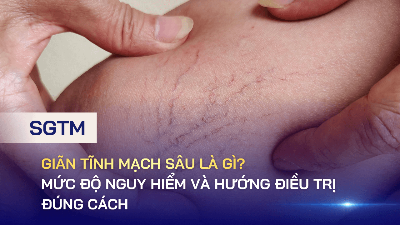 Giãn tĩnh mạch sâu