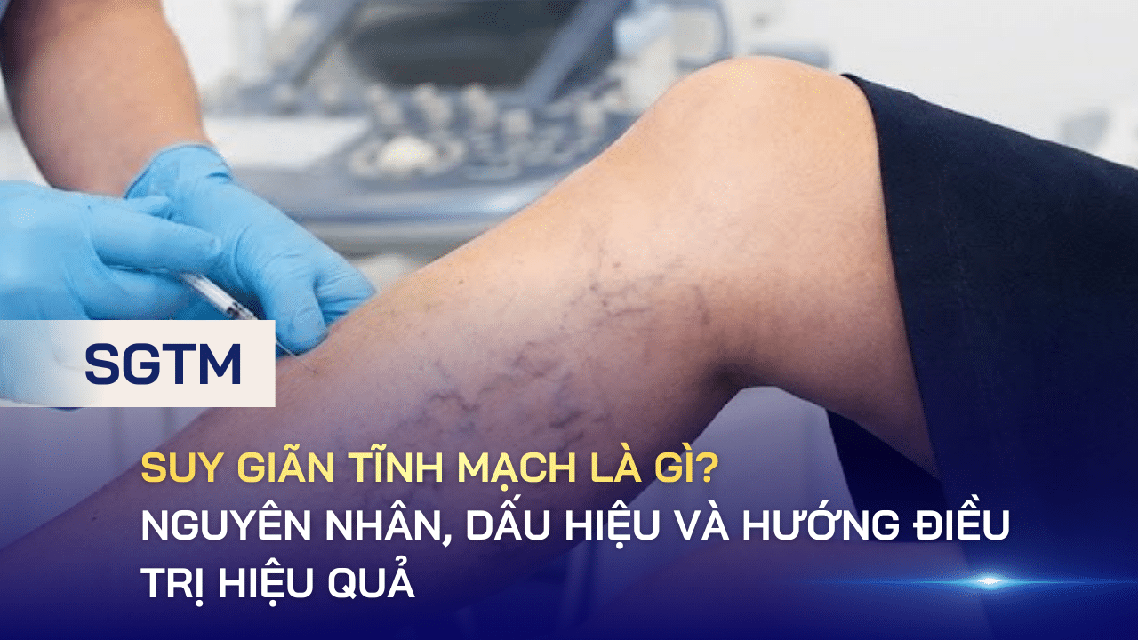 Suy giãn tĩnh mạch là gì? Nguyên nhân, dấu hiệu và hướng điều trị hiệu quả