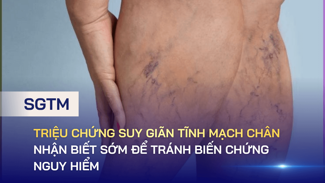 Triệu chứng suy giãn tĩnh mạch