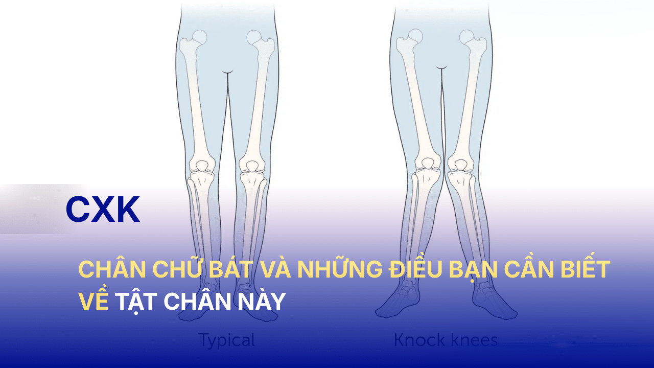 Chân chữ bát và những điều bạn cần biết về tật chân này