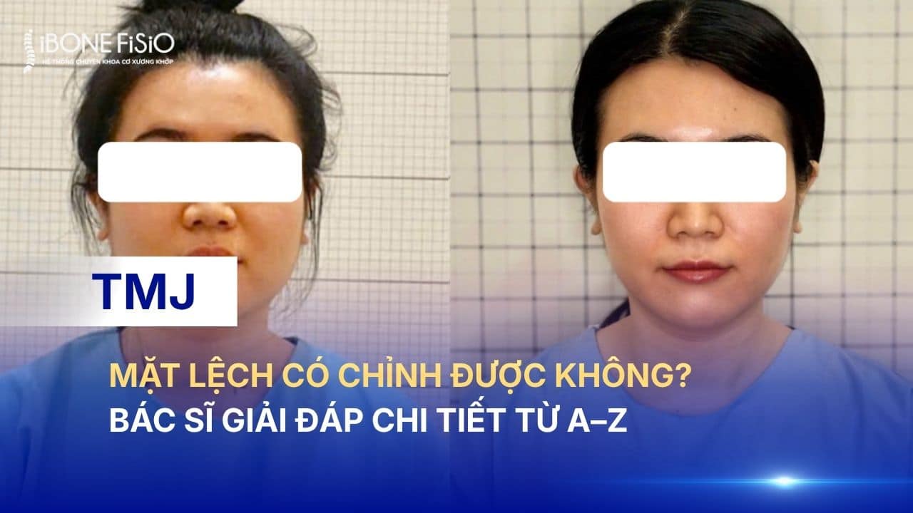 Mặt lệch có chỉnh được không? Bác sĩ giải đáp chi tiết từ A–Z