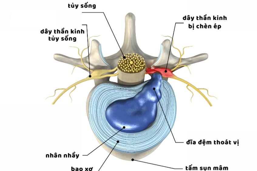 Cấp độ 3: Thoát vị tự do, cấp độ thoát vị đĩa đệm có triệu chứng gây ảnh hưởng đến sinh hoạt Cấp độ 3: Thoát vị tự do, cấp độ thoát vị đĩa đệm có triệu chứng gây ảnh hưởng đến sinh hoạt